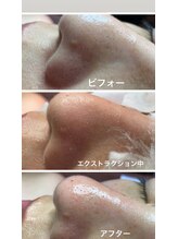 リンカ(Rinca)/エクストラクションの工程/毛穴