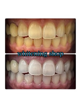 ホワイトニングショップ 大阪玉造店/Before&After美白ホワイトニング