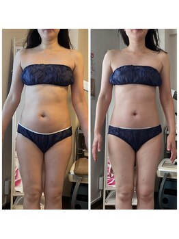 ビューティアップ 茶屋町店(Beauty Up)/【光痩身コース】1回での変化!