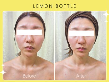 ハノハノ 八代店(HANO HANO)/【八代初導入!】レモンボトル☆