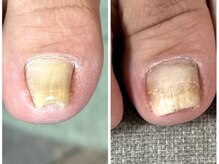 オツメヤ(otsumeya)/ジェルで巻き爪ケア