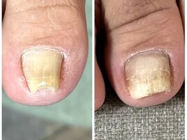 ジェルで巻き爪ケア