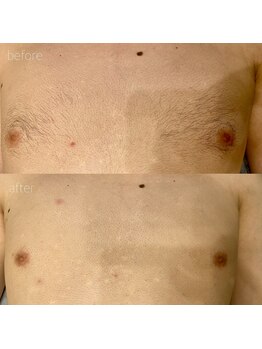 オンセ(once)/胸脱毛/乳輪脱毛/全身脱毛