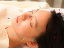 ミイ鍼灸院(mie鍼灸院)/美容鍼1　お顔のハリUP