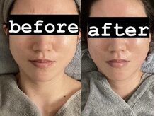 ディライト 名古屋駅店(Delight)/ハイパーナイフフェイシャル