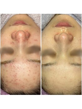 ディンプル(Dimple)/肌質改善　フェイシャル　シミ