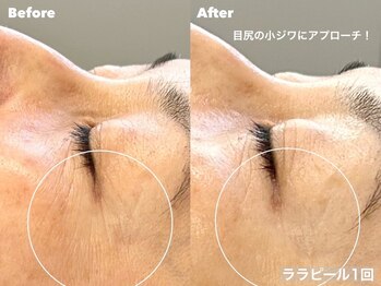 ルチア 博多店(Lucia)/韓国肌管理★話題のララピール♪