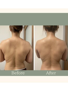 エステ大阪PON/大人気!背中スリミング