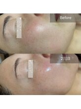 エルモア(L-MORE)/韓国美肌管理　ララピール