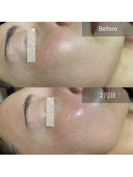 エルモア(L-MORE)/韓国美肌管理　ララピール