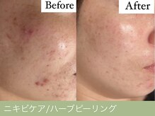 オーエン 小倉店(o-eN)/ニキビケア/ハーブピーリング