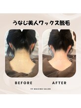 トリプルワン(111)/うなじ脱毛