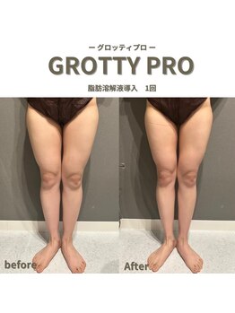 フルアナ(Hu ruana)/痩身/ダイエット/筋膜リリース