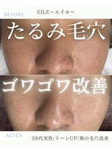 エイル(EILE)/症例4