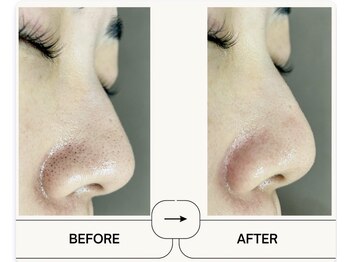 メルト 中目黒(Melt.)の写真/【毛穴詰まり/黒ずみ対策◎】徹底毛穴ケアで澄んだ透明感とキメの整ったツヤ肌へ。