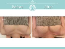 美人バスト 渋谷店/【バストアップ・育乳】◇症例◇