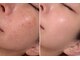 ドクターマジックタッチ(Dr.MAGIC TOUCH)の写真/毛穴・黒ずみ・くすみに。大人のための透明感フェイシャル