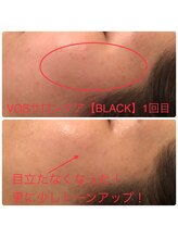 ラ ルミエール(La Lumiere)/サロンケアBLACK1回の変化！-2
