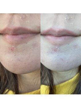 ディライト 名古屋駅店(Delight)/ハーブピーリングハード(DTあり)