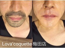 ラヴァコケット 梅田店(Lova'coquette)/SNSで話題☆お髭のワックス脱毛