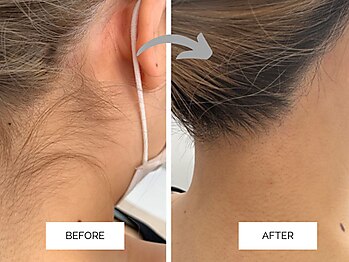 リンネ(Rin'ne)/[部分脱毛] 襟足スッキリ♪