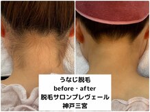 プレヴェール 神戸三宮/うなじ脱毛