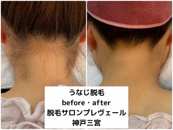 プレヴェール 神戸三宮/うなじ脱毛