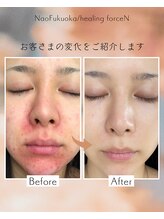 ナオフクオカ ヒーリングフォースエヌ(NaoFukuoka/healingforceN)/全身ケア＆estherでのホームケア