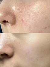 マリヴェリーテ(Mari verite)/毛穴洗浄×セラピール【8回】