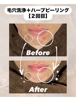 ビレボ マエバシ(BEREVO maebashi)/Before After