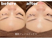 ホワイトラボ 堺東(White labo)/【20代女性 施術1回の効果】