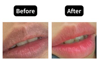 モンロー(MonroE+)/黒ずみ・くすみ・色素ケア