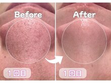 オーキッド(ORCHID)の雰囲気（《人気の『毛穴』ケア》毛穴の汚れや角栓を吸引♪）