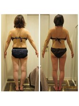 痩身脱毛専門店 グレイスボディ MEGAドンキホーテ三郷店(Gracebody)/◆痩身　症例写真