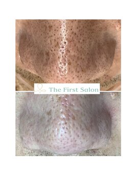 ザ ファーストサロン(The First Salon)/毛穴ケア 男性にも人気上昇中