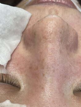 キキ(kiki)/毛穴汚れが排出中