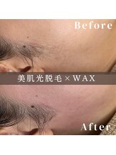 エピナ 千葉店(Epina)/フェイシャルMIX脱毛☆