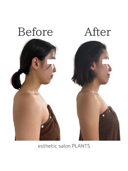 プランツ(PLANTS)/20代後半／３回／首肩こり・小顔