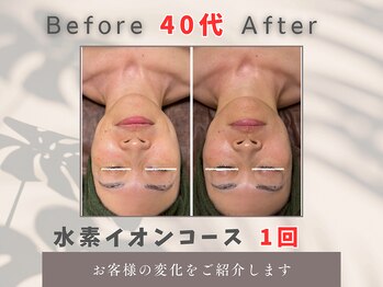 トータルビューティー雅/水素イオン+微振動波の相乗効果