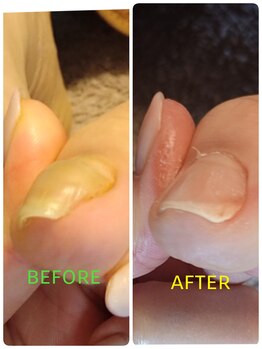 フットスタジオ アルク(FOOT STUDIO ALUK)/【巻き爪補正】巻き爪ケア