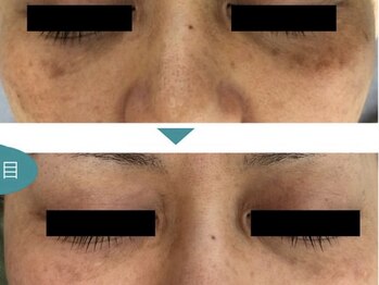 パルファンカルム 駅西本町店/脱!シミくすみ!陶器肌へ!