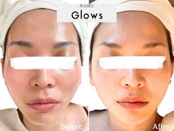 グロウズ(Glows)/お顔の左右差も改善できます!