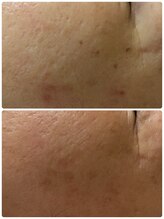 ルーメ(lume)/シミケア59代女性