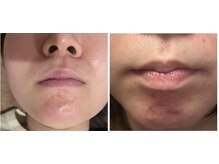 美リレア/しつこいニキビケア＆肌質改善