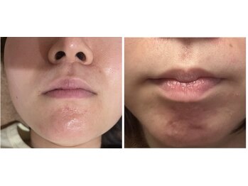 美リレア/しつこいニキビケア＆肌質改善