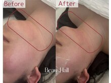 ビノスビューティー(vinos.beauty)/韓国から上陸！脂肪分解