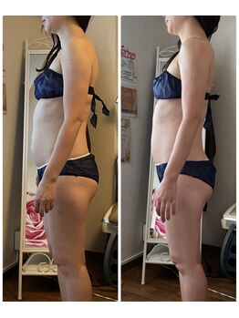 ビューティアップ 茶屋町店(Beauty Up)/【光痩身コース】1回での変化!