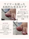 ワイヤーで本格的な巻き爪ケア