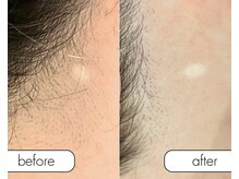 アール(R;)/脱毛効果