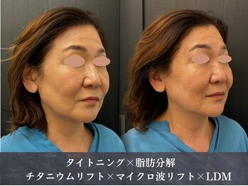 イロハ(IROHA)の写真/年齢を感じない若々しいお顔へ*年齢を重ねるたびに気になるお顔のたるみに!エステ以上の仕上がりをご提供♪
